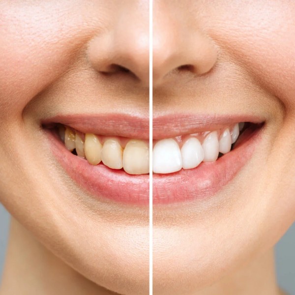 blanqueamiento-dental-dentista-rocio-velasco