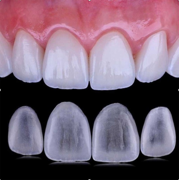 carillas-dentales-rocio-velasco