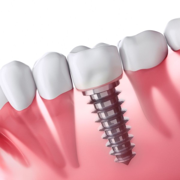 implantes-dentales-dentista-rocio-velasco