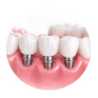 Prótesis sobre implantes